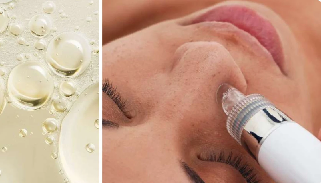 Tratament de microdermabraziune facială